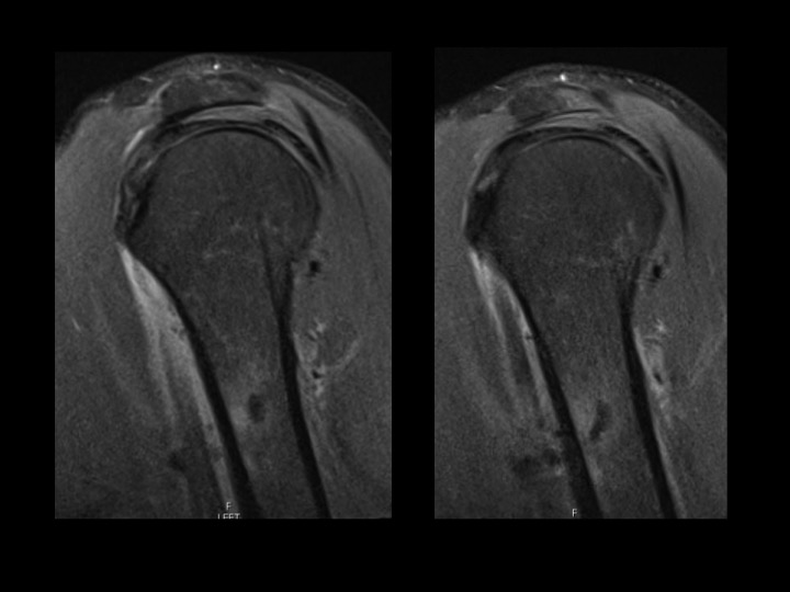 Figure 3 for case tendon of pectoralis major ( RID2007 )